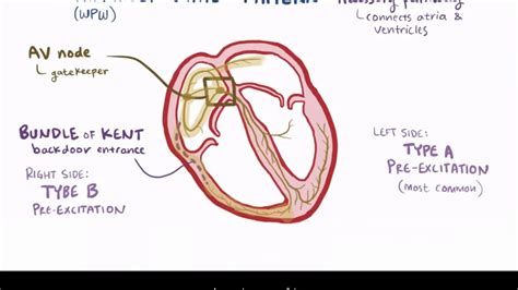 Bundle Of Kent Anatomy