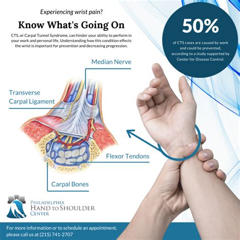 What Is Carpal Tunnel Syndrome? - Philadelphia Hand to Shoulder Center