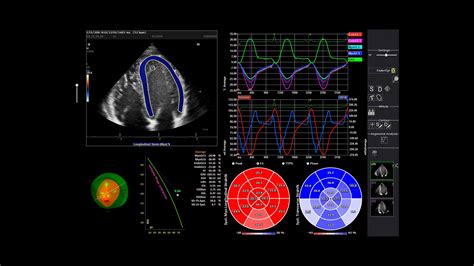 ACUSON Juniper, CV Edition Ultrasound System - Siemens Healthineers