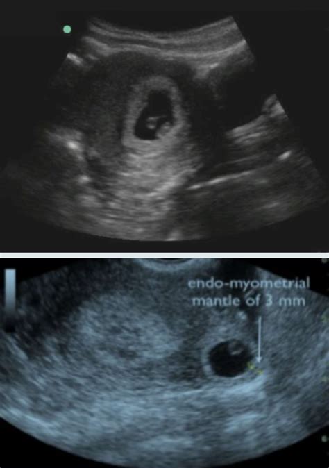 Ectopic Pregnancy Ultrasound