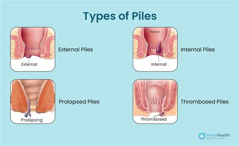 Piles - Symptoms, Meaning, Images, Causes and Types