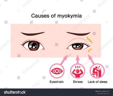 Causes Myokymia Eyelid Twitch Tic Vector Stock Vector (Royalty Free) 2096877154 | Shutterstock