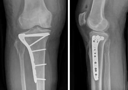 Tibial Plateau Fracture | Orthopaedic Trauma Association (OTA)