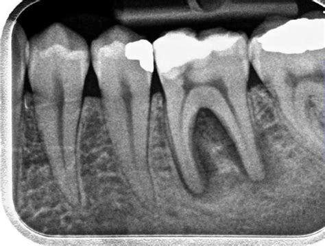 Root Canal Infection Xray