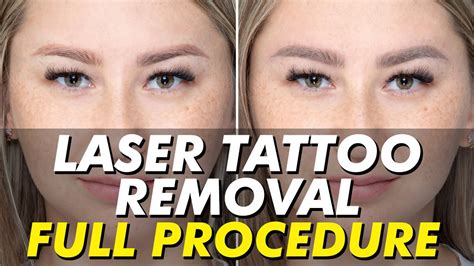 Makeup Tattoo Laser Removal | Saubhaya Makeup