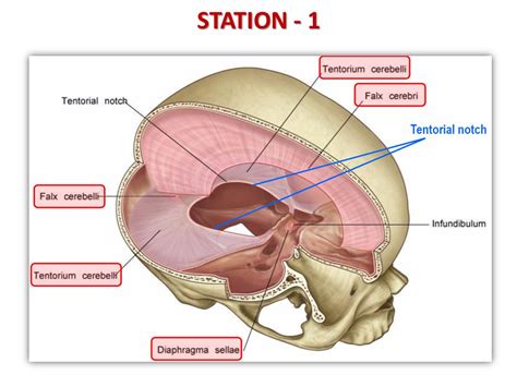 Tentorium Cerebelli Cadaver