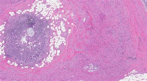 Goblet cell adenocarcinoma of... - Ottawa Atlas of Pathology