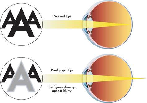 Presbyopia Treatment & Surgery | Toledo LASIK