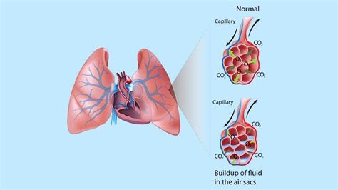 Pulmonary Edema: Symptoms, Diagnosis, Prevention | Christ Memorial