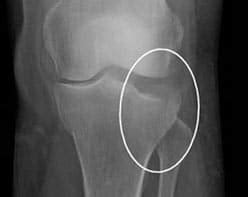 diagnosis-for-tibial-plateau-fracture - Emergency Medicine Cases