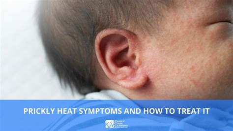 Prickly Heat Symptoms and How to Treat It