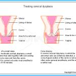 Cervical Dysplasia Treatment - AllYogaPositions.com