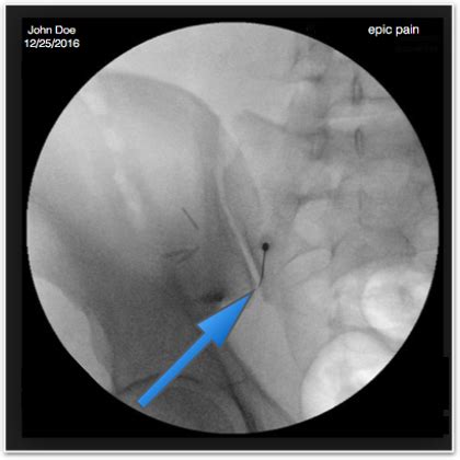 Sacroiliac Joint Injection & Radiofrequency Ablation at Epic Pain Management