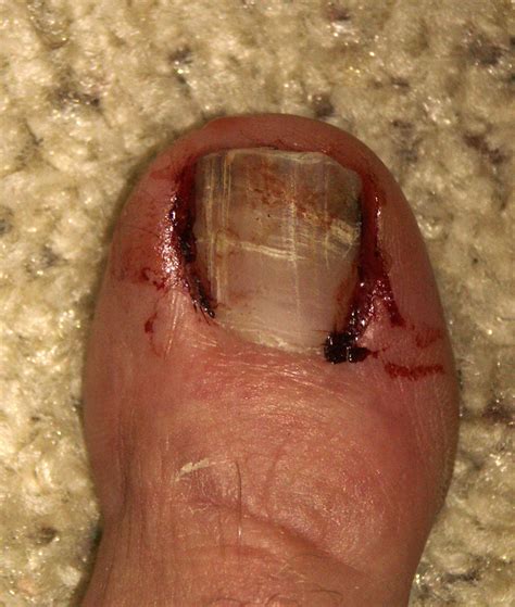 Ugly Toe # 2 | OK, so I was trying to move the tractor and c… | Flickr