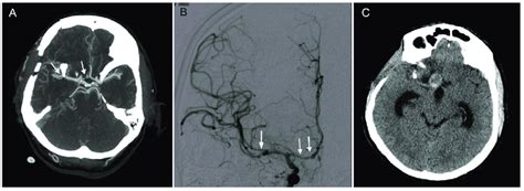 Clipping of a ruptured middle cerebral artery (MCA) aneurysm ...