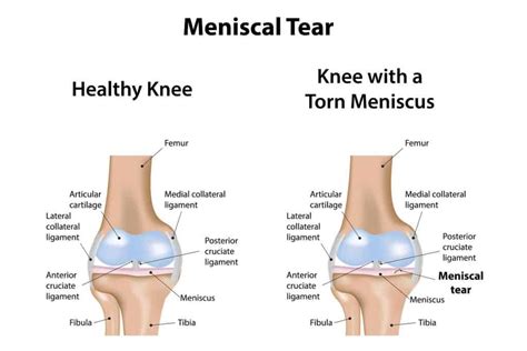 Causes and Diagnosis of a Meniscal Tear | Blackberry Clinic Blog