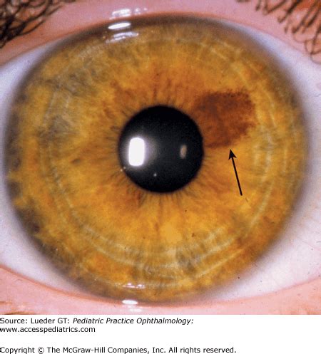 Disorders of the Iris and Pupil | Ento Key