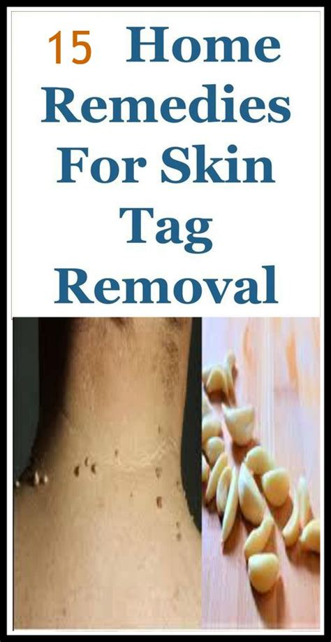 15 Effective Home Remedies For Skin Tag Removal