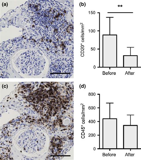 (a) Representative CD20 staining. (b) Allograft CD20-positive cells ...