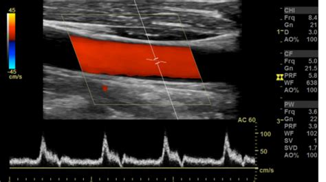 Arterial Doppler/Duplex of the Lower Extremities – Sonographic Tendencies in 2022 | Lower ...