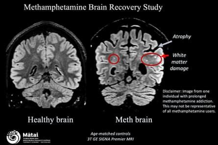 Can brains bounce back? Recovering addicts turn to science to map the ...