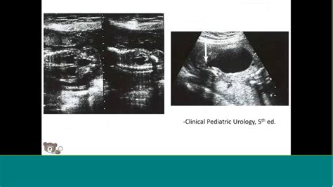 Fetal Hydronephrosis - YouTube