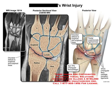 Wrist Injury