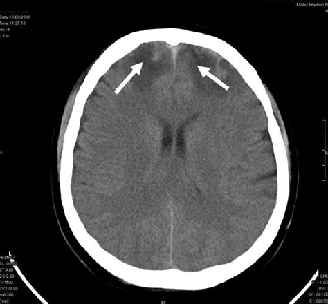 Contusion Cerebral