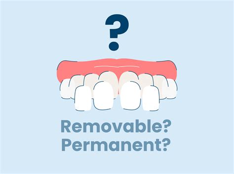 Are Veneers Permanent or Removable?