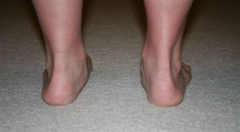 Correcting Overpronation | Overpronation, Posture fix, Exercise