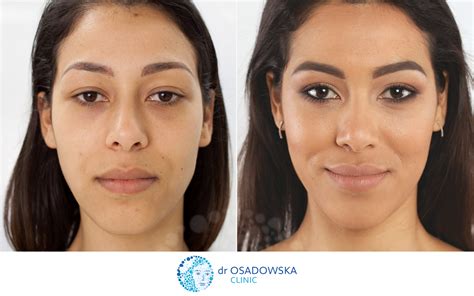 Real photos Upper eyelid laser surgery, before and 6 months after - Dr Osadowska Clinic Poland