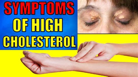 Signs and Symptoms of High Cholesterol YOU NEED TO KNOW - YouTube