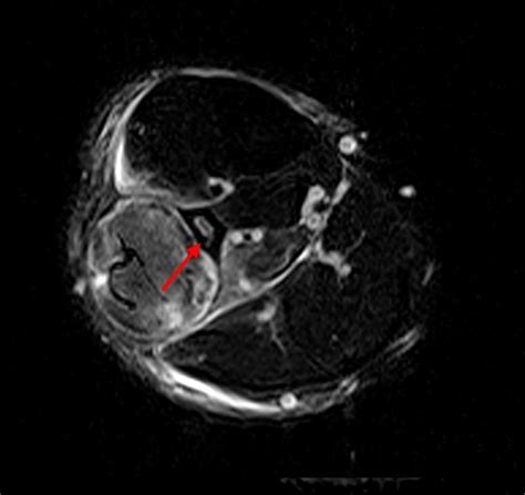 Compartment Syndrome of the Leg | Radsource