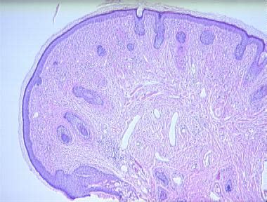 angiofibroma histopathology - Loma Linda Dermatopathology