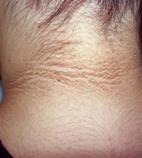 Disorders of Pigmentation - Sinclair Dermatology