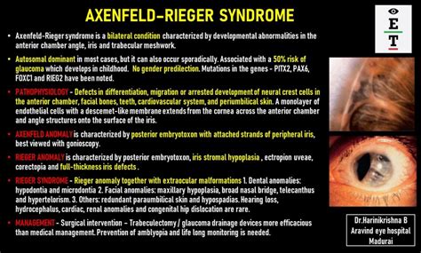 Axenfeld–Rieger Syndrome - EyeToday