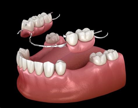 What Is the Difference Between Partial Dentures and Dental Bridges?