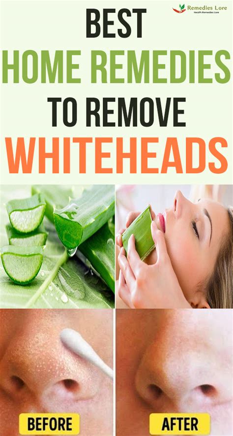 Best Home Remedies To Remove whiteheads - Remedies Lore