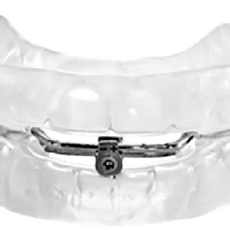 Mandibular Advancement Device | Download Scientific Diagram