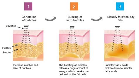 ultrasound-cavitation – The Global Beauty Group