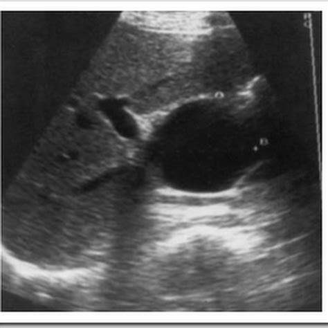 Ultrasound images Choledochal cyst paediatric abdomen - Radiology Imaging