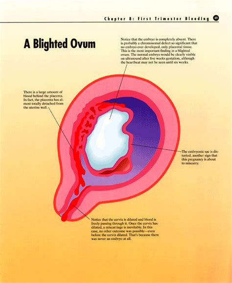 First Trimester Bleeding image 2