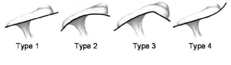 Types Of Acromion Shapes