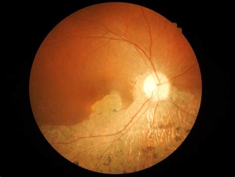 Macular Hole - What is It, Causes and Treatment Options - Asia Retina ...