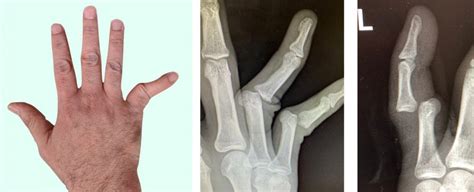 Dislocated Knuckle