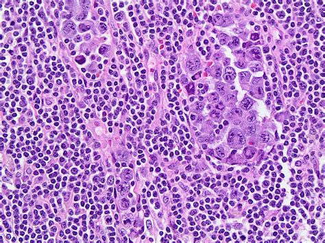 Pathology Outlines - Anaplastic large cell lymphoma, ALK positive