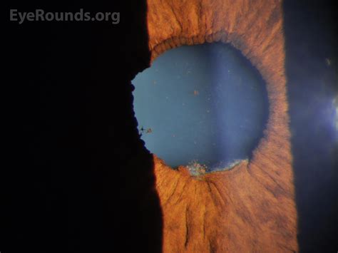 File:EyeRounds Case 334, Fig1-slit-lamp-posterior-synechiae-LRG.jpg - NC Commons