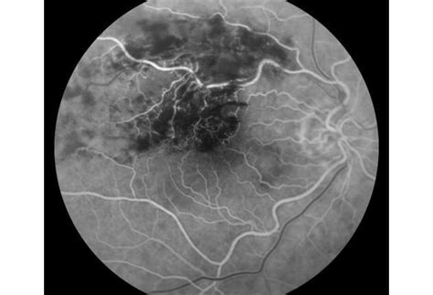 BRVO, Branch Retinal Vein Occlusion, BRVO Eye, BRVO Treatment