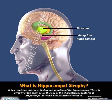 What is Hippocampal Atrophy & How is it Treated? | Alzheimer's disease, Memory loss, Treatment