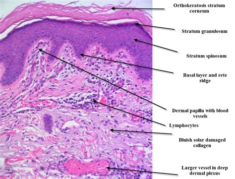 Dermatopathology Made Simple - Inflammatory: Introduction to skin histopathology